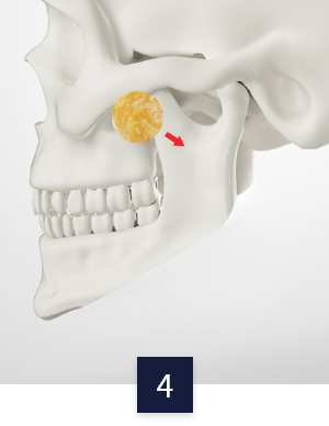 square-jaw_method4.png square-jaw_method4.png