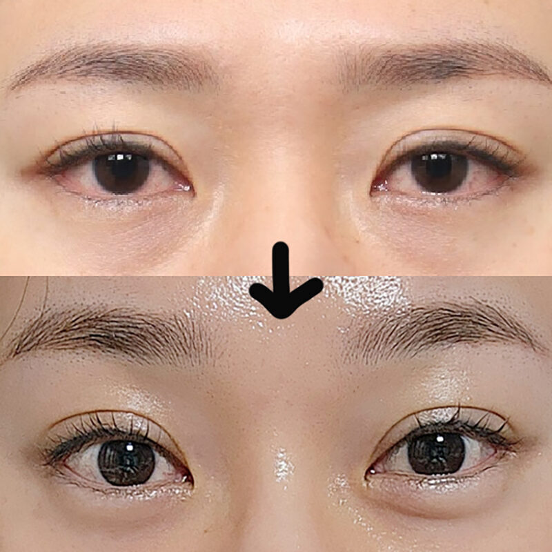 #5060이마거상 #눈썹뼈절삭