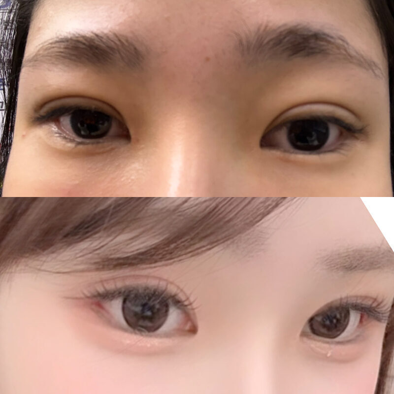#5060이마거상 #뒤트임 #밑트임
