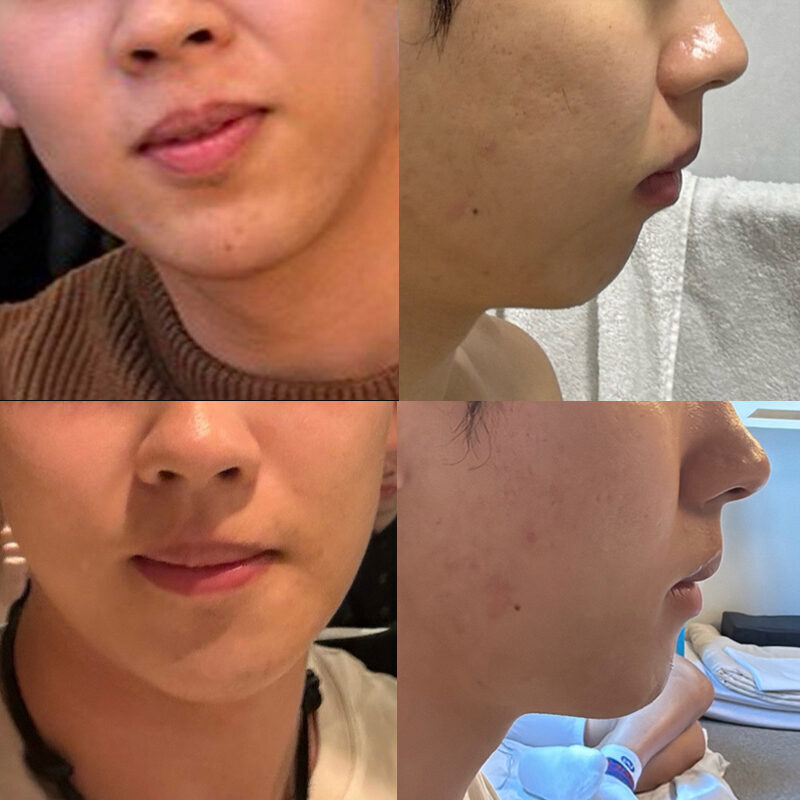 #턱끝전진술 #턱끝축소술