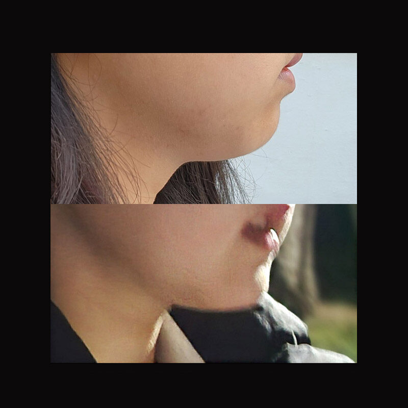#턱끝전진술