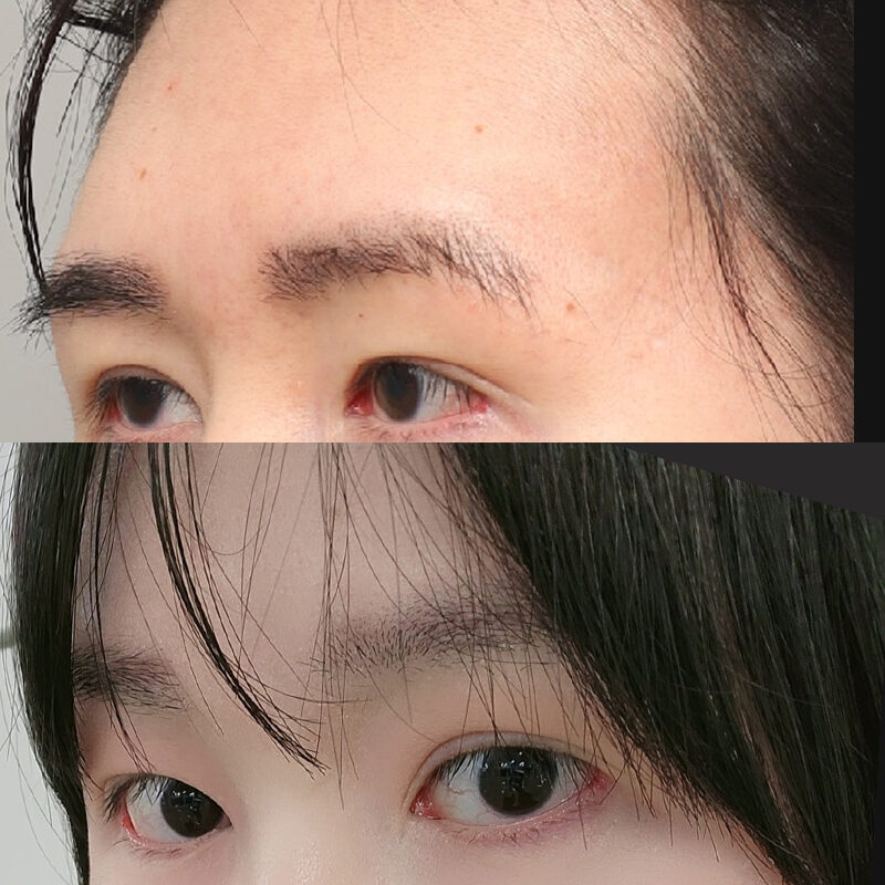 #눈썹뼈절삭 #이마지방이식
