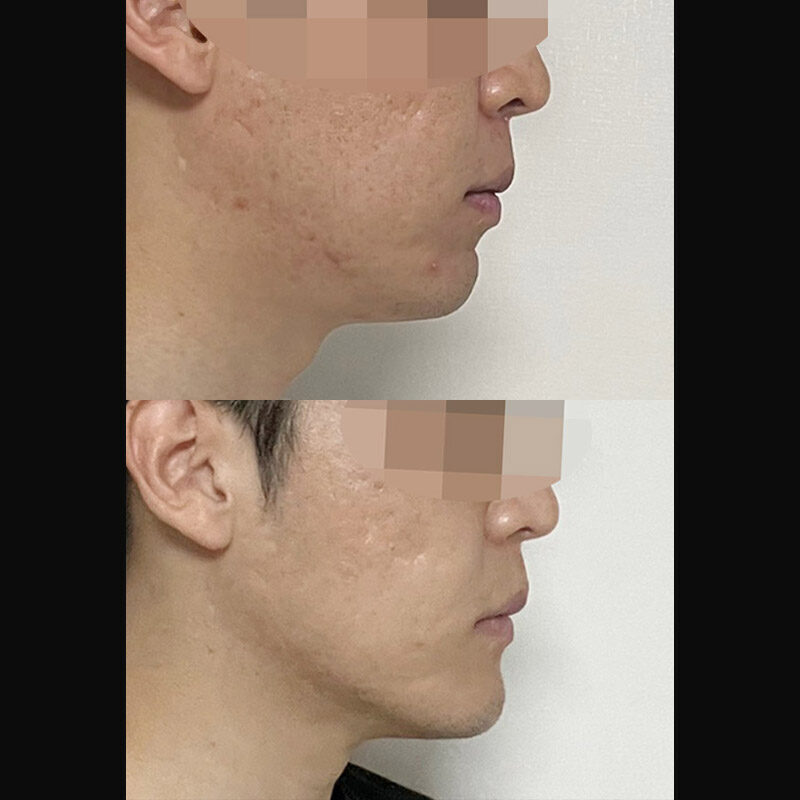 #턱끝전진술