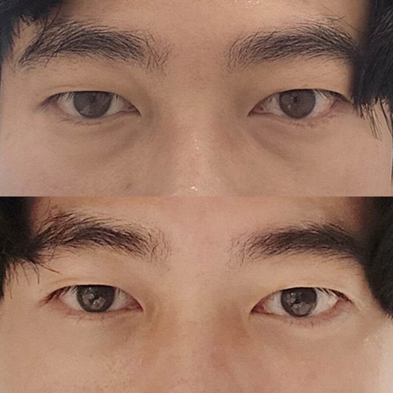 #눈밑지방재배치 #눈밑지방이식