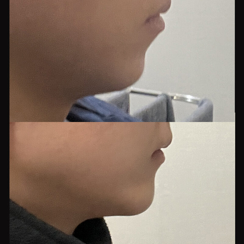 #턱끝전진술