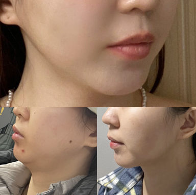 #이중턱지우개흡입 #눈밑지방재배치