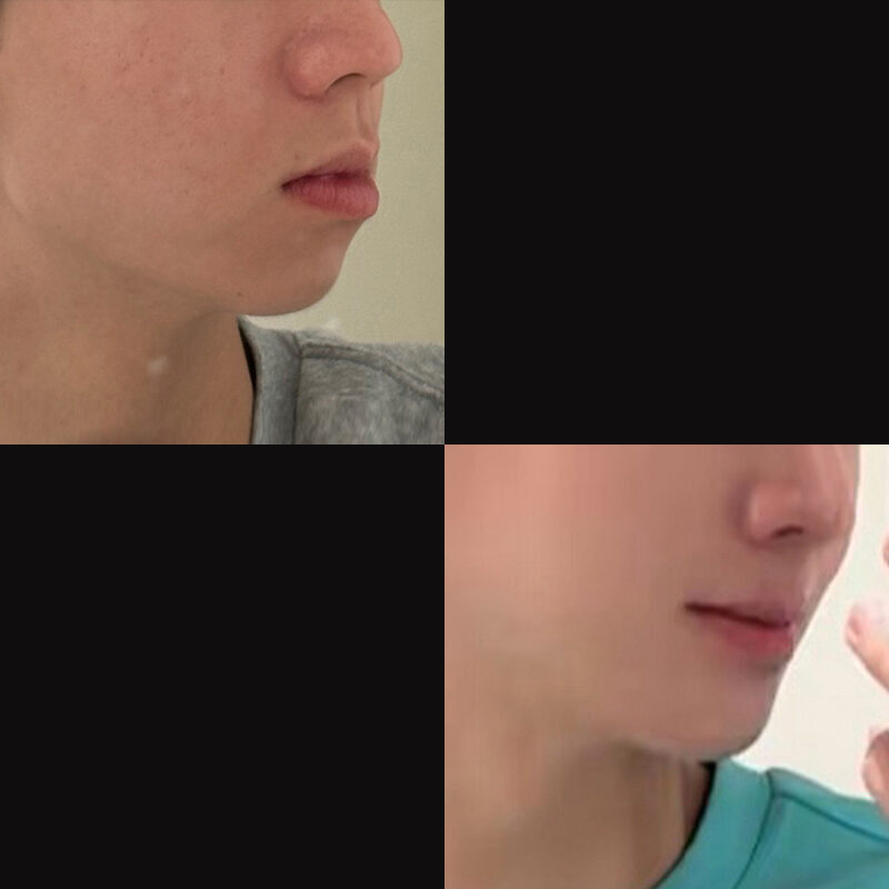 턱끝전진술