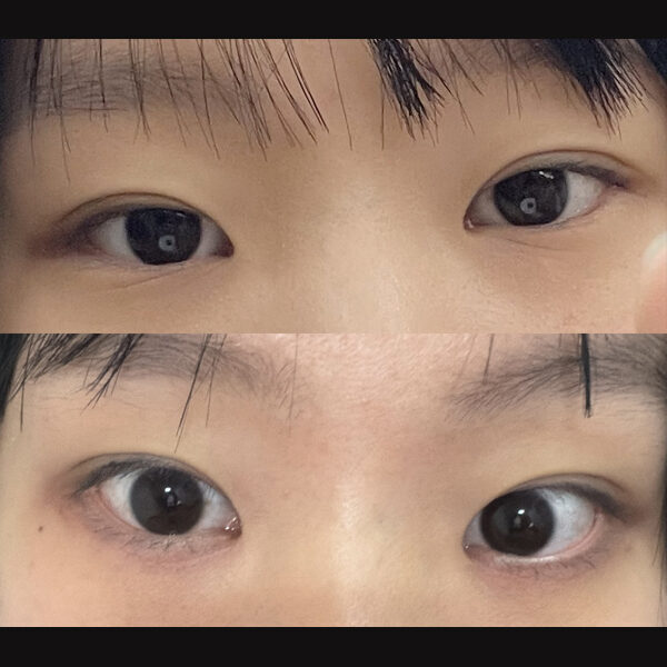 #아래눈꺼풀피부절제