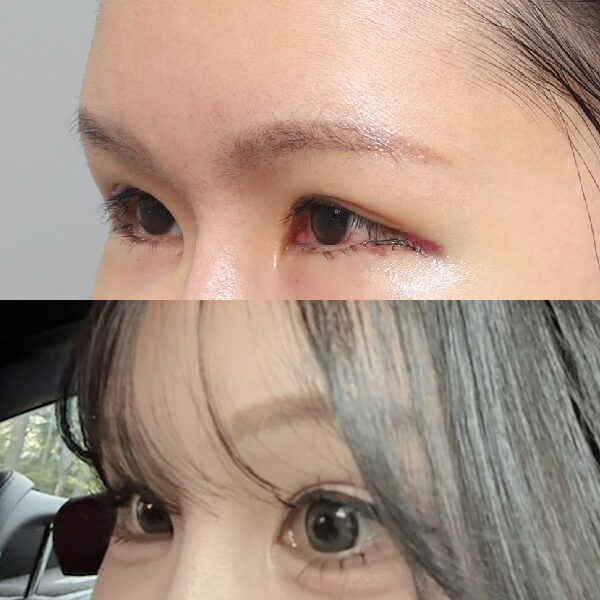 #눈썹뼈절삭 #이마거상플러스