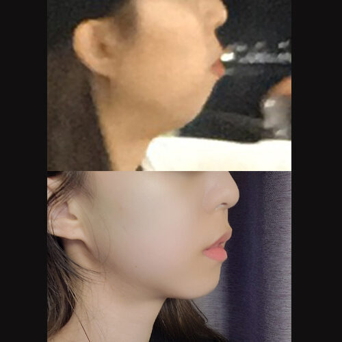 #턱끝전진술