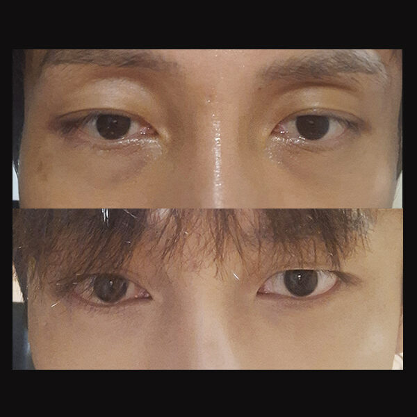 #눈밑지방재배치 #눈밑지방이식 #눈위지방이식