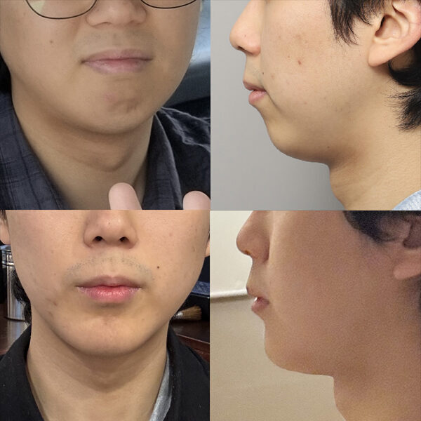 #턱끝전진술