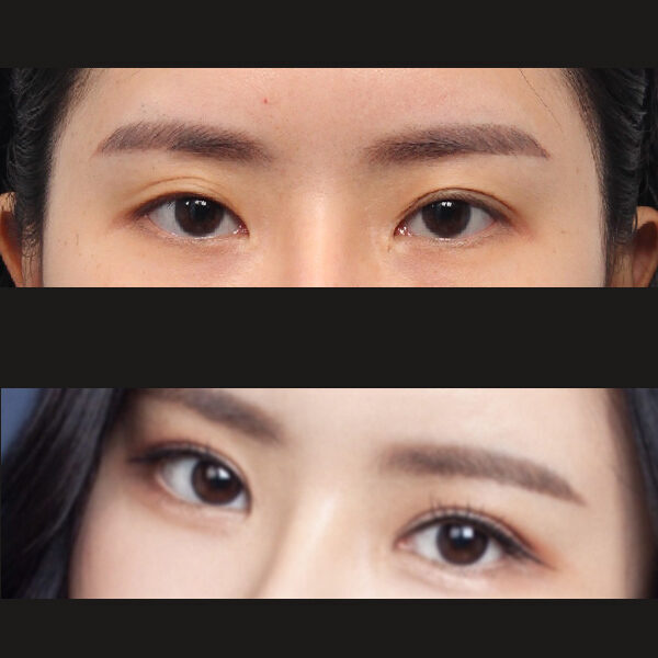 #자연유착 #비절개눈매교정