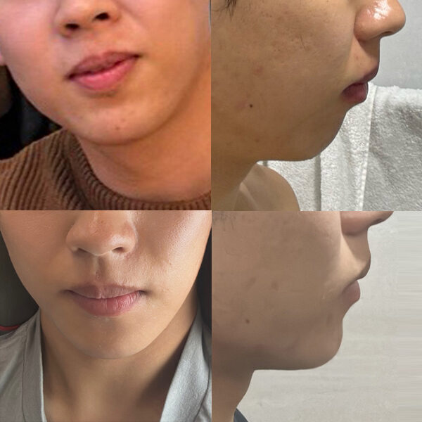 #턱끝전진술