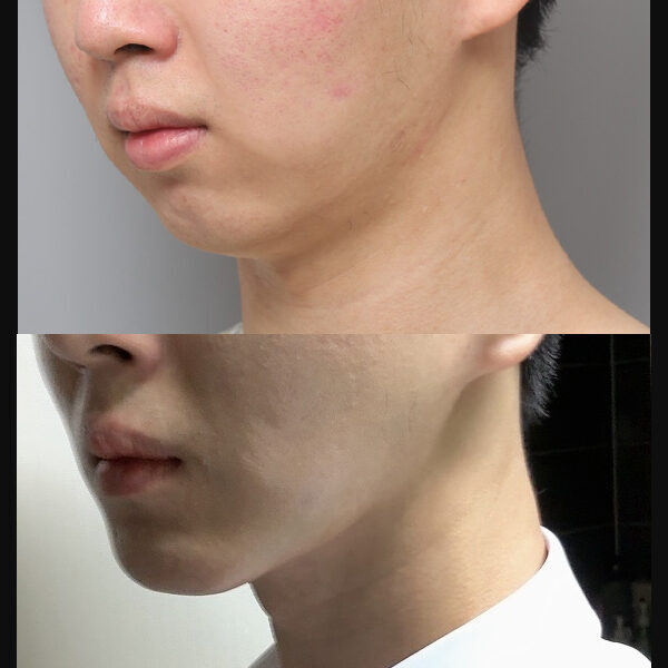 #턱끝전진술