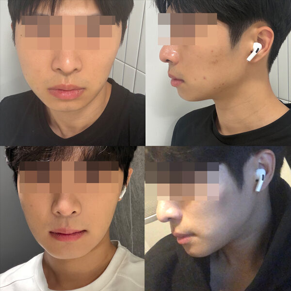 #턱끝전진술