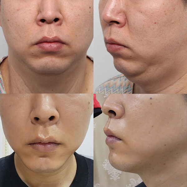 #이중턱지우개흡입 #턱끝전진술