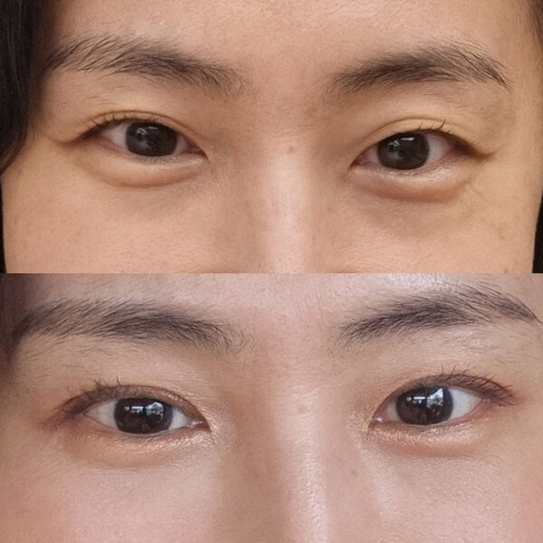 #자연유착 #눈밑지방재배치