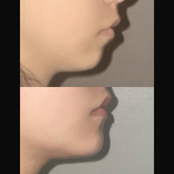 #턱끝전진술