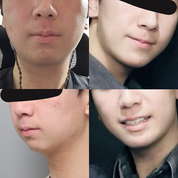 #턱끝전진술
