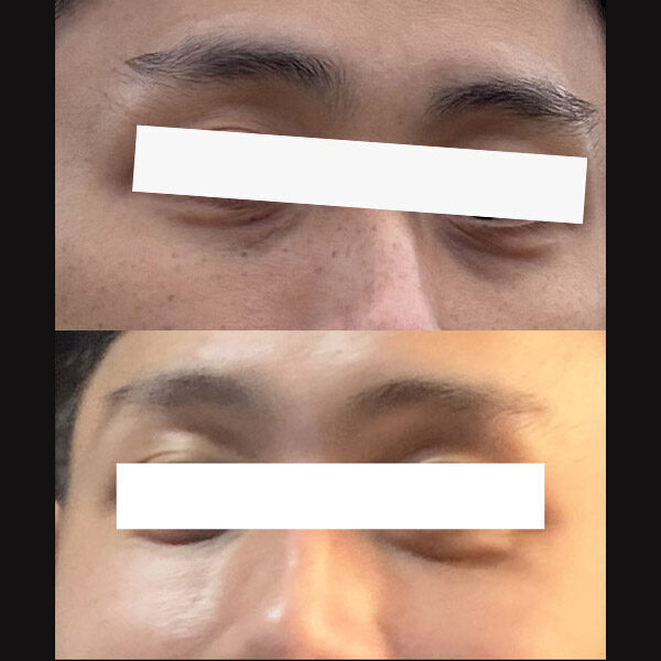 #눈밑지방재배치 #눈밑지방이식