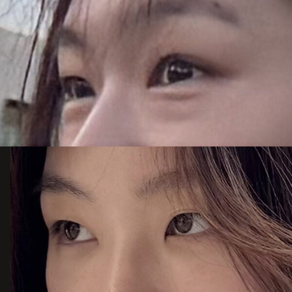 #눈밑지방재배치 #눈밑지방이식