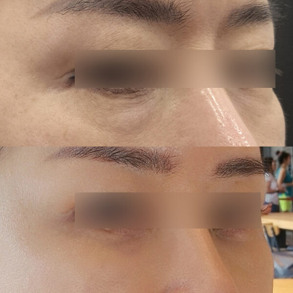 #눈밑지방재배치 #눈밑지방이식