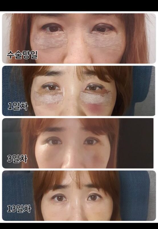 #쌍꺼풀(매몰)#눈매교정#눈밑지방재배치#눈물골지방이식