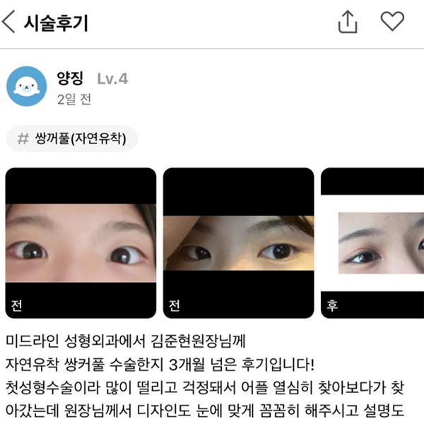 #쌍꺼풀(자연유착)#쌍꺼풀#매몰#자연유착#눈성형#눈