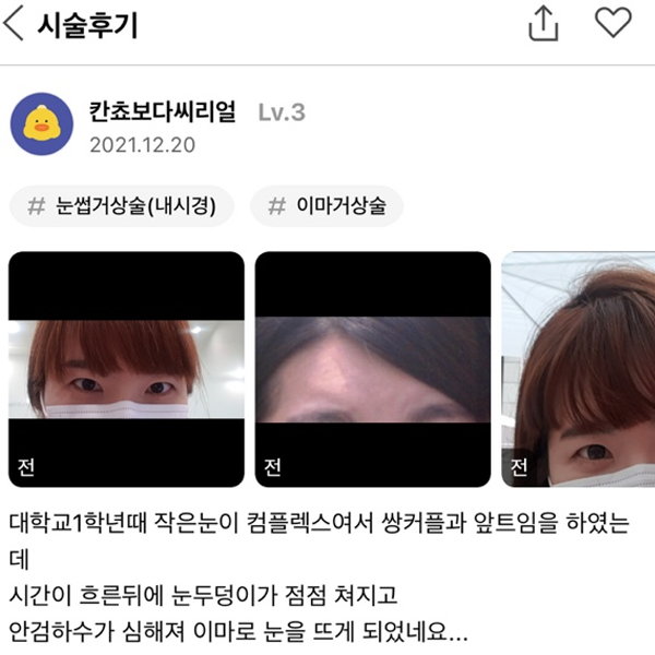 #이마거상술#이마거상#눈썹거상술(내시경)#내시경이마거상