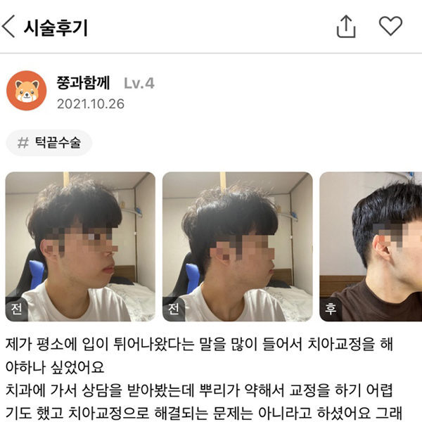 #안면윤곽#미드라인성형외과의원#턱끝수술#턱끝전진#김준현원장#윤곽수술