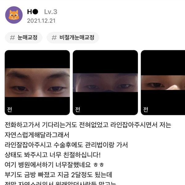 #눈매교정#비절개눈매교정