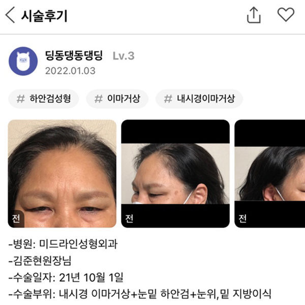 #동안성형#이마성형#미드라인성형외과의원#하안검#지방이식#김준현원장