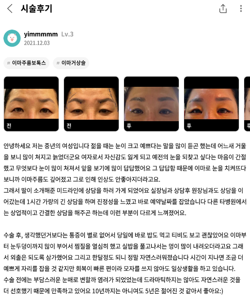 #이마거상술#이마주름보톡스#이마거상