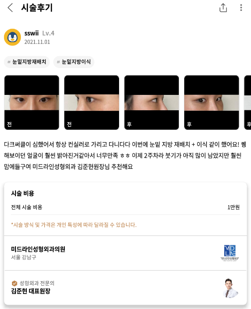 #눈밑지방재배치#눈밑지방이식
