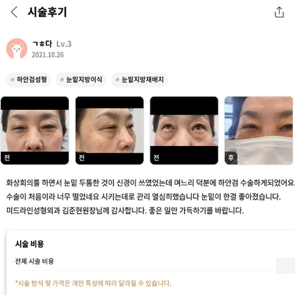 #하안검성형#눈밑지방이식#눈밑지방재배치