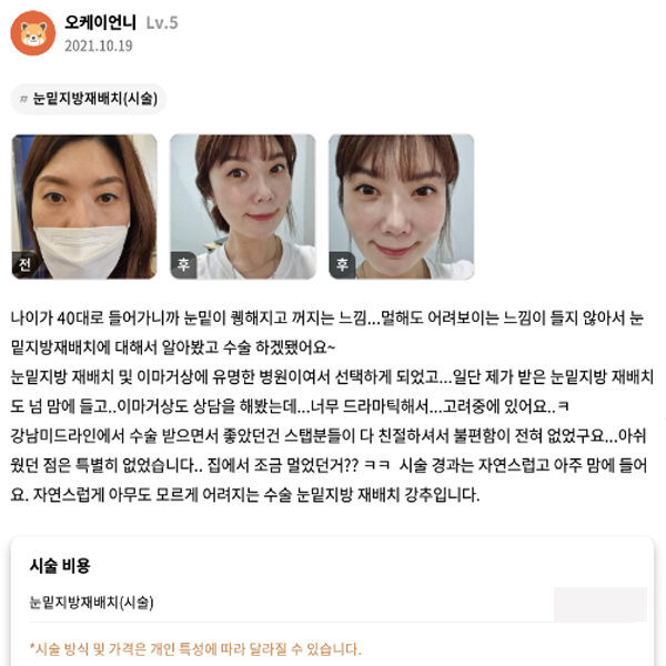 #눈밑지방재배치