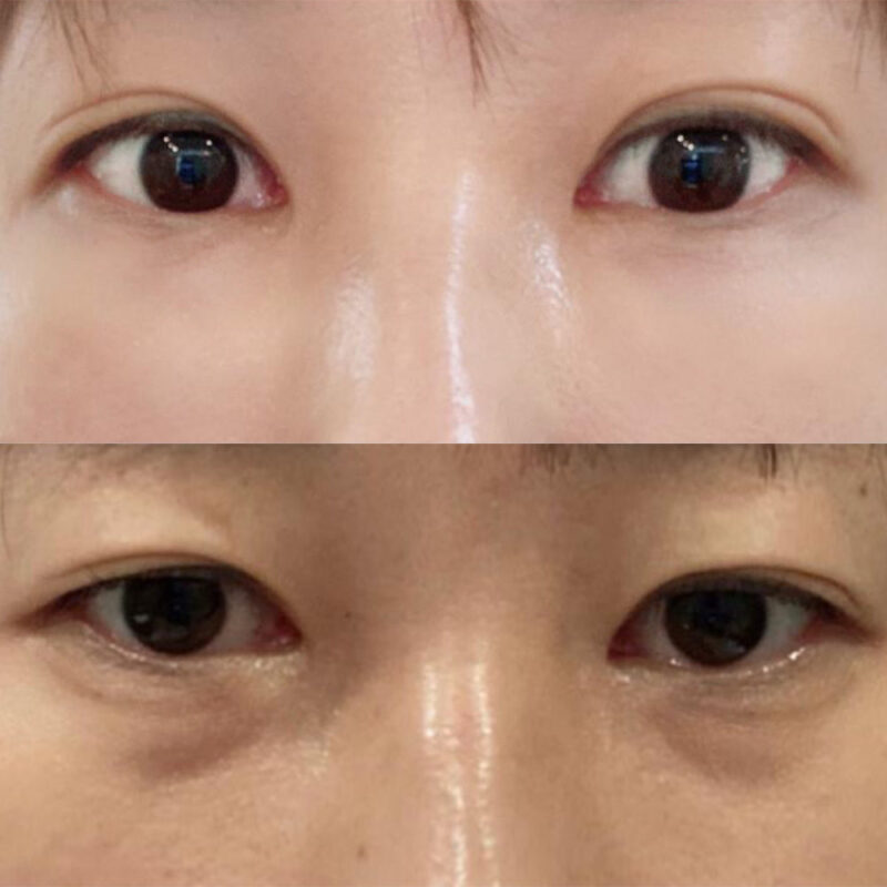 #눈밑지방재배치#눈밑지방이식