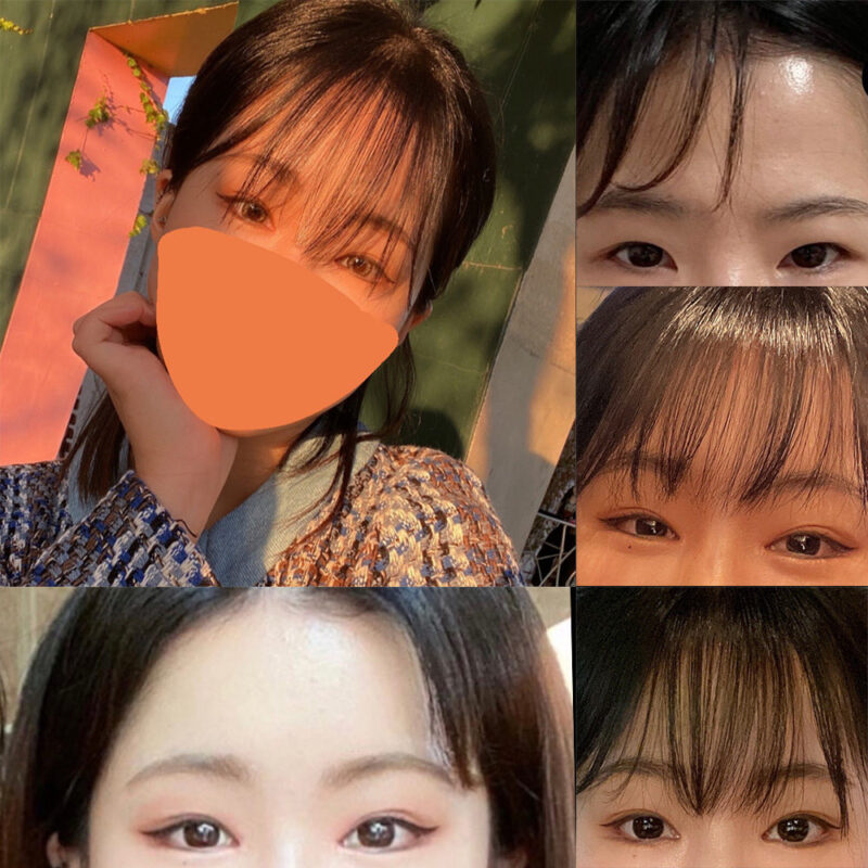 #이마거상#내시경이마거상술#뒤트임#밑트임#앞트임재수술