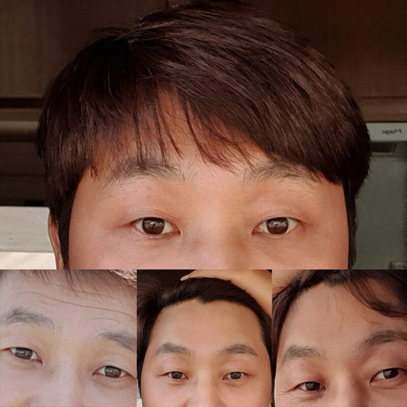 #내시경이마거상술