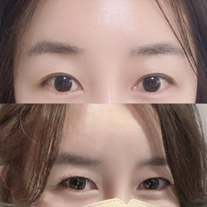 #이마거상#내시경이마거상술
