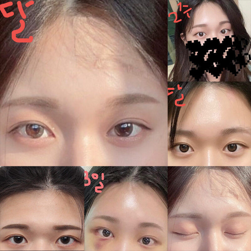 #이마거상#내시경이마거상술