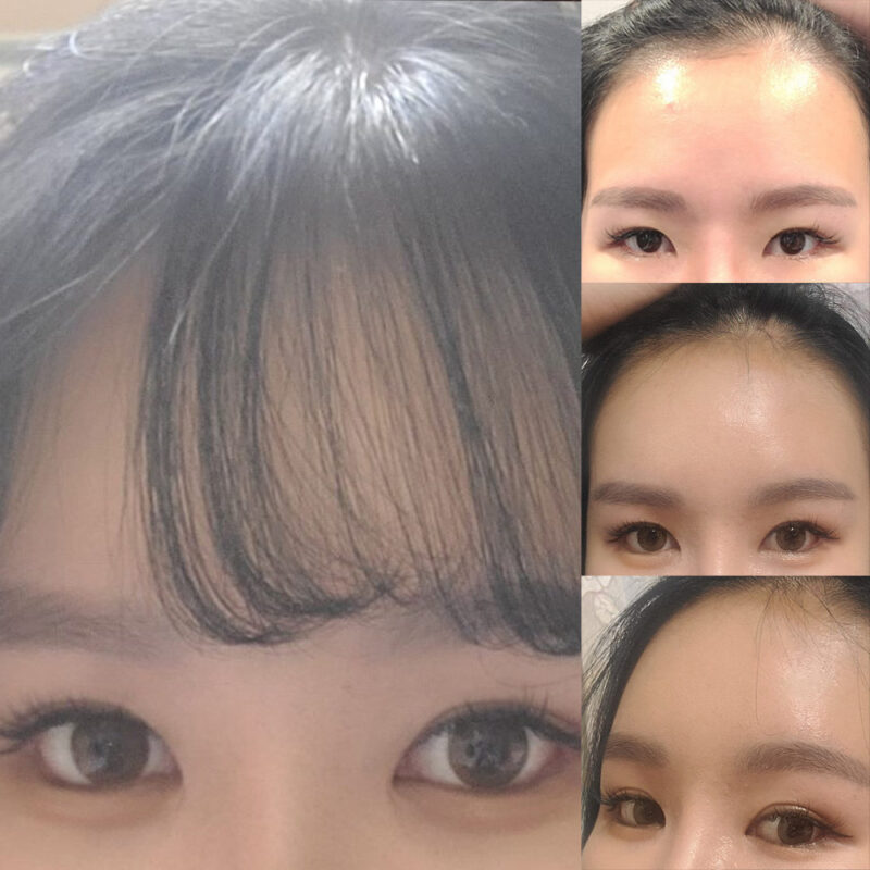 #이마거상#내시경이마거상술