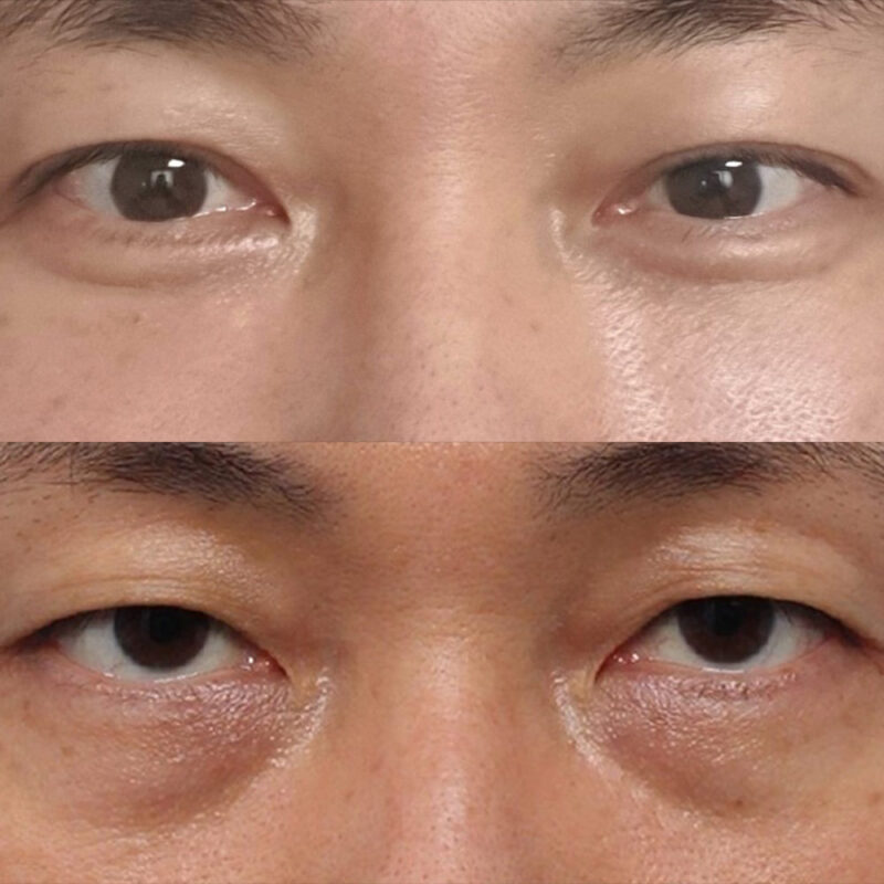 #하안검#눈밑지방재배치#눈밑지방이식#쌍꺼풀(자연유착+눈매교정)