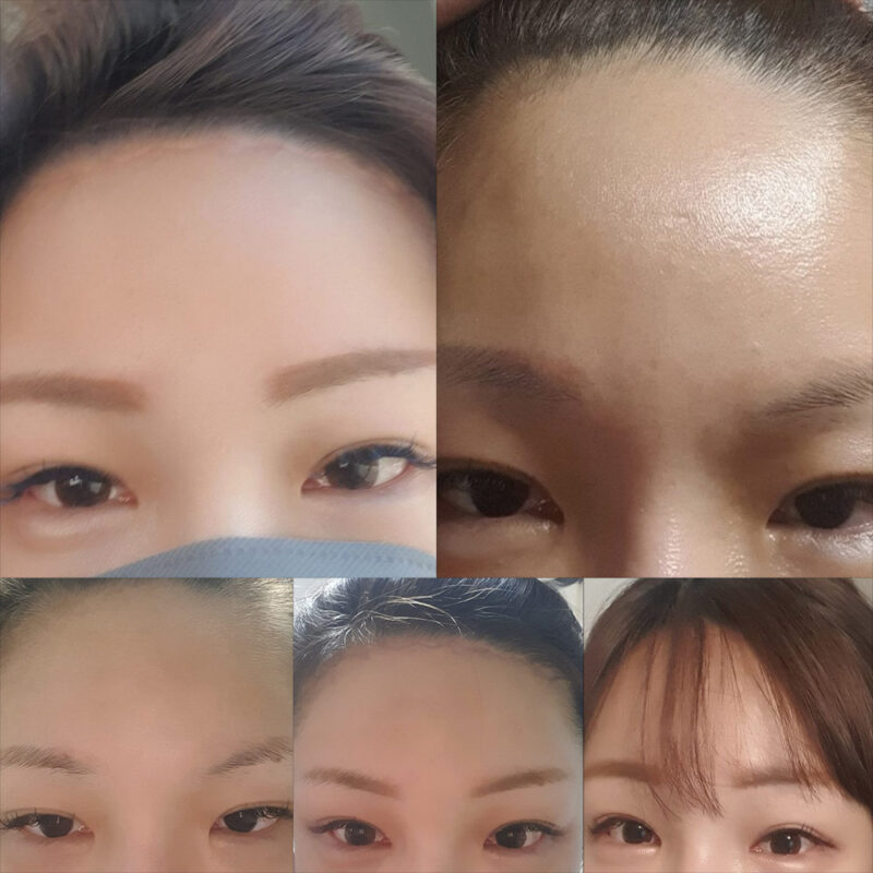 #이마거상#내시경이마거상술#이마축소