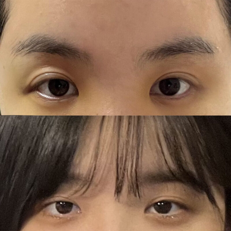 #이마거상#내시경이마거상술