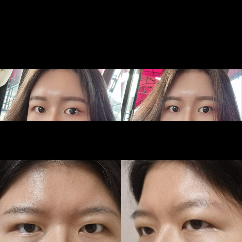 #이마거상#내시경이마거상술