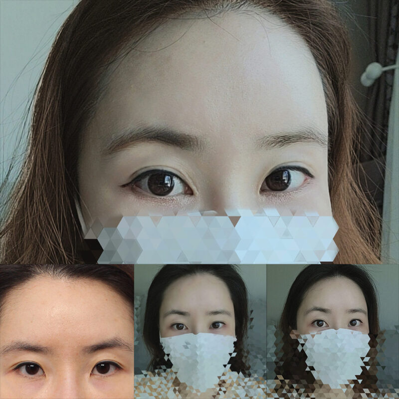 #이마거상#내시경이마거상술#하안검#눈밑지방이식#앞트임#뒤트임