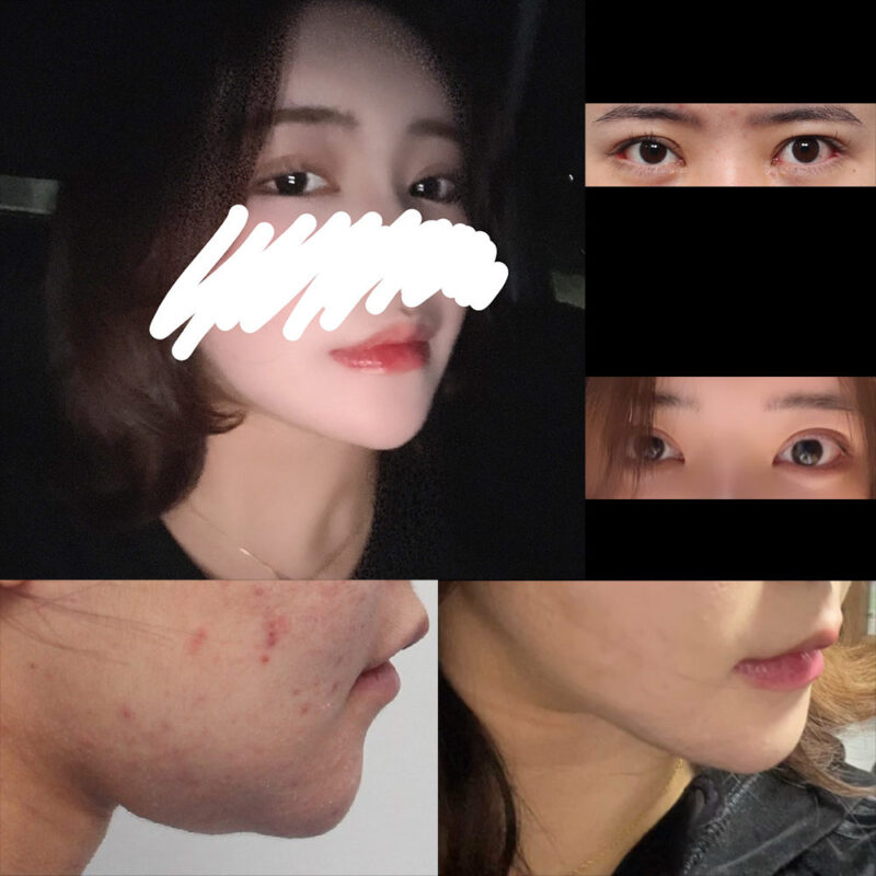 #이마거상#내시경이마거상술#밑트임#뒷트임#턱끝전진#이중턱,턱선지방흡입