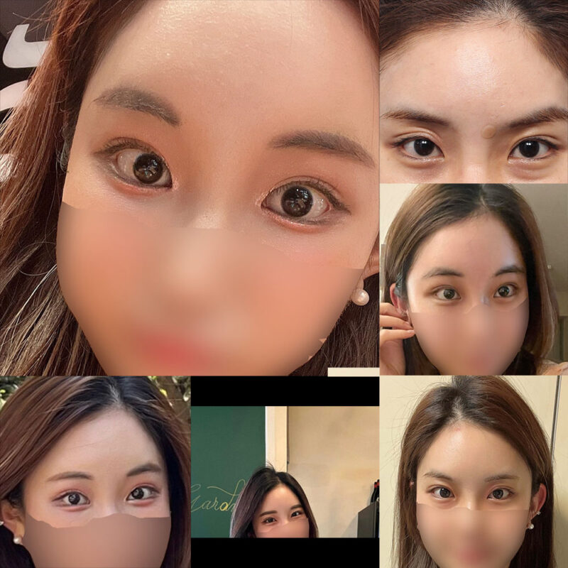 #이마거상#내시경이마거상술#눈밑지방재배치#눈밑,눈위지방이식